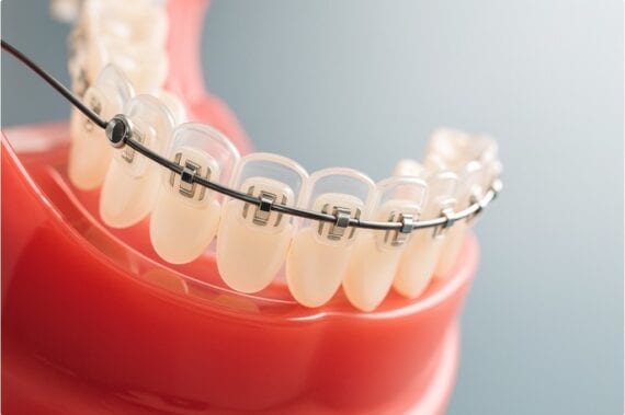 Herausnehmbare Zahnspangen