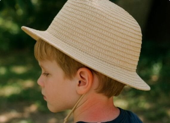 Sonnenbrand im Kindesalter